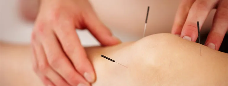 Warkworth Acupuncture — Acupuncturists in Warkworth