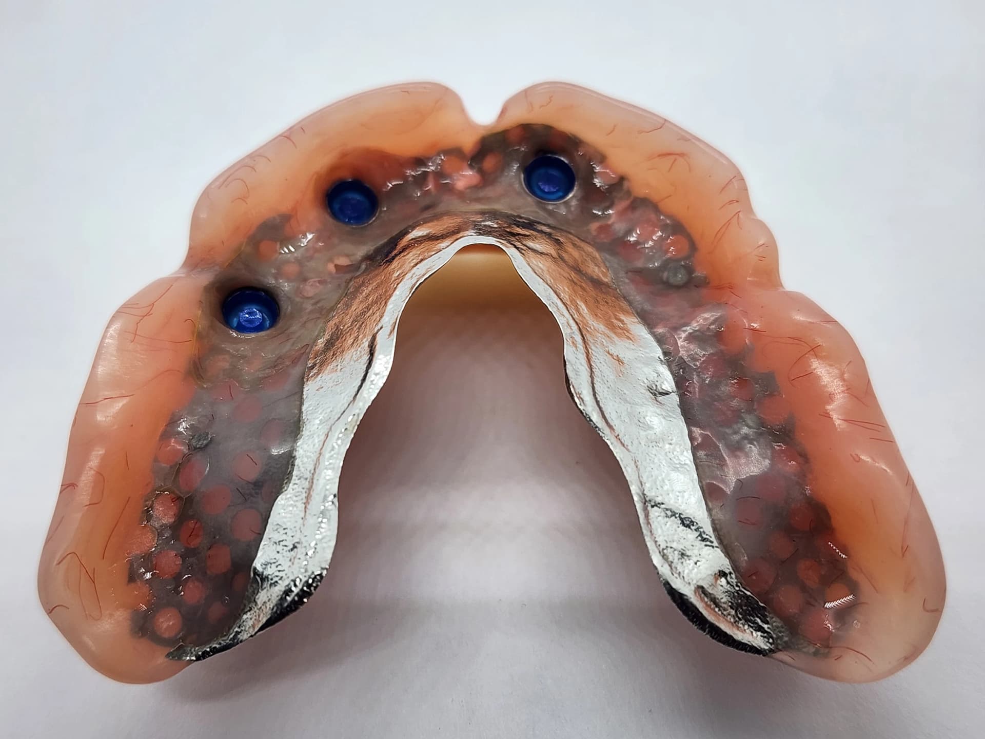 Designer Dentures — Dentists in Ōtara-Papatoetoe